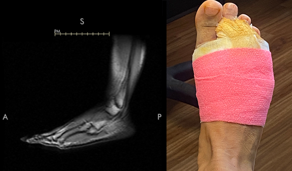 Foot X-Ray Left Bandaged Foot after Surgery Right